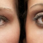 How keratopigmentation Is Transforming Modern Cosmetic Ophthalmology